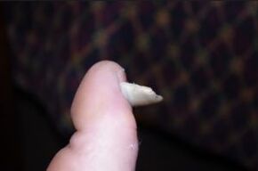 Síntomas de cogomelos nas uñas