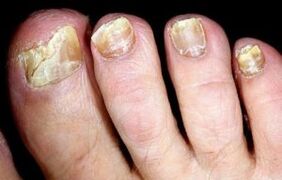 Síntomas de fungo das unhas dos pés
